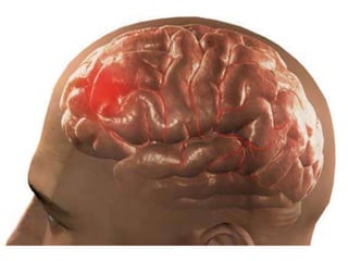 Cerebral vascular accident   stroke