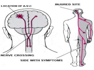 Cerebral vascular accident   stroke