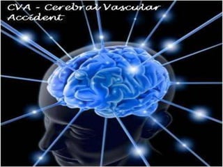 Cerebral vascular accident   stroke