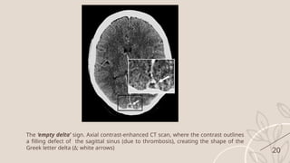 Imaging and Management of Cerebral Venous Thrombosis: CT and MRI ...