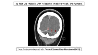 31-Year-Old Presents with Headache, Impaired Vision, and Aphasia.
These finding are diagnostic of a Cerebral Venous Sinus Thrombosis (CVST).
 