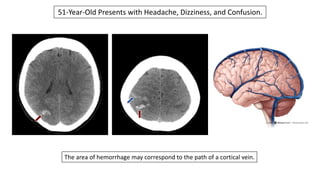51-Year-Old Presents with Headache, Dizziness, and Confusion.
The area of hemorrhage may correspond to the path of a cortical vein.
 