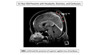 51-Year-Old Presents with Headache, Dizziness, and Confusion.
MRV: confirmed the presence of superior sagittal sinus thrombosis.
 