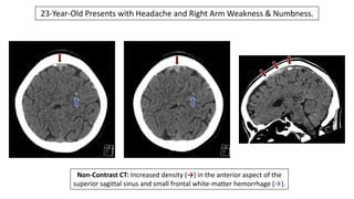 23-Year-Old Presents with Headache and Right Arm Weakness & Numbness.
Non-Contrast CT: Increased density (→) in the anterior aspect of the
superior sagittal sinus and small frontal white-matter hemorrhage (→).
 