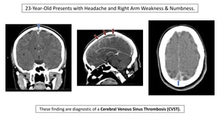 These finding are diagnostic of a Cerebral Venous Sinus Thrombosis (CVST).
23-Year-Old Presents with Headache and Right Arm Weakness & Numbness.
 
