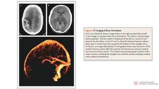 CMC Neuroimaging Case Studies - Cerebral Venous Sinus Thrombosis