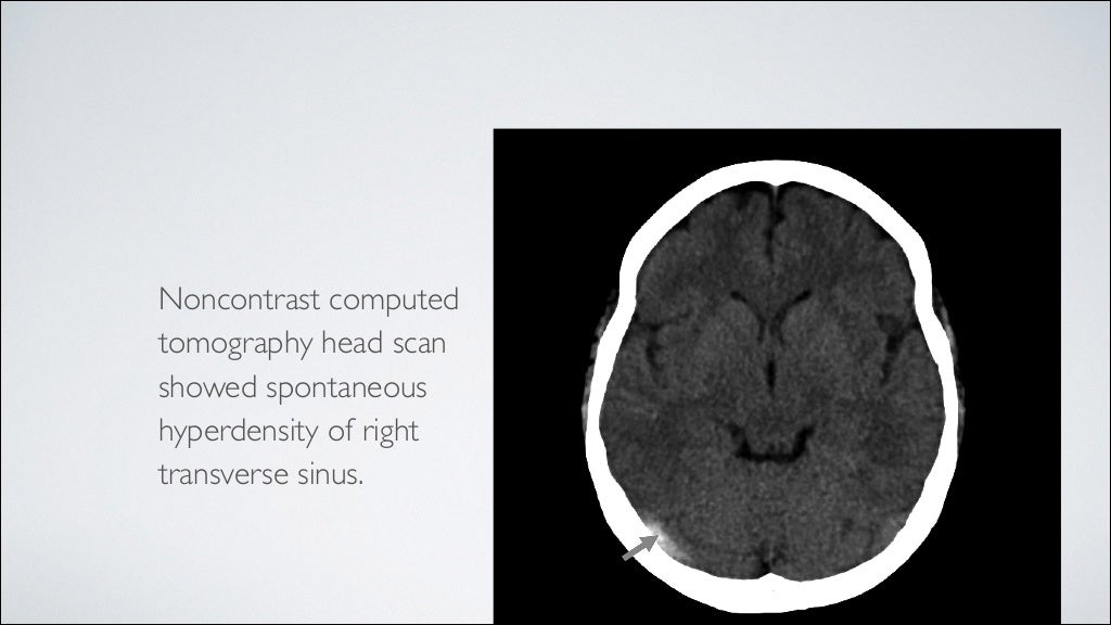 Cerebral sinuses venous thrombosis