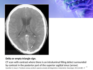 Cerebral Venous Thrombosis by TSAMO NDOMO V MD MPH.pptx