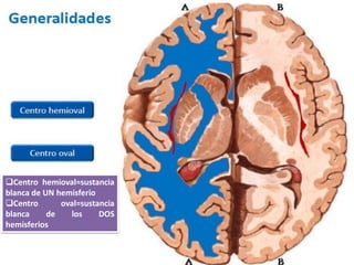 Centrohemioval=sustanciablancadeUNhemisferio 
Centrooval=sustanciablancadelosDOShemisferios  