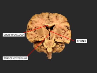 CUERPO CALLOSO
FORNIX
TERCER VENTRICULO
 