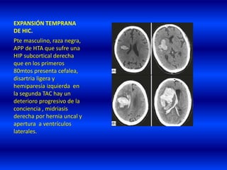 EXPANSIÓN TEMPRANA
DE HIC.
Pte masculino, raza negra,
APP de HTA que sufre una
HIP subcortical derecha
que en los primeros
80mtos presenta cefalea,
disartria ligera y
hemiparesía izquierda en
la segunda TAC hay un
deterioro progresivo de la
conciencia , midriasis
derecha por hernia uncal y
apertura a ventrículos
laterales.
 