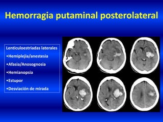Hemorragia putaminal posterolateral
Lenticuloestriadas laterales
•Hemiplejia/anestesia
•Afasia/Anosognosia
•Hemianopsia
•Estupor
•Desviación de mirada
 
