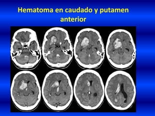 Hematoma en caudado y putamen
anterior
 