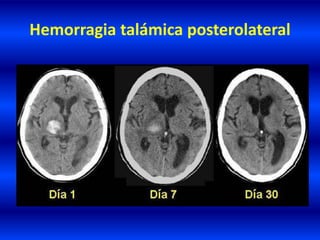 Hemorragia talámica posterolateral
 