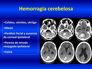 Hemorragia cerebelosa
•Cefalea, vómitos, vértigo
•Ataxia
•Parálisis Facial y ausencia
de corneal ipsilateral
•Paresia de mirada
conjugada ipsilateral
•Coma
 
