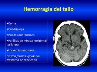 Hemorragia del tallo
•Coma
•Cuadriplejia
•Pupilas puntiformes
•Parálisis de mirada horizontal
ipsilateral
•Locked in syndrome
Existen formas ligeras sin
trastorno de conciencia
 