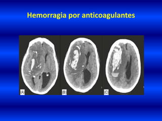 Hemorragia por anticoagulantes
 