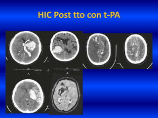 HIC Post tto con t-PA
 