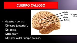 CUERPO CALLOSO
• Muestra 4 zonas:
Rostro (anterior),
Rodilla,
Tronco y
Esplenio del Cuerpo Calloso.
 