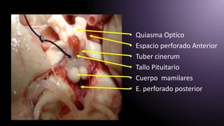 • Quiasma Optico
• Espacio perforado Anterior
• Tuber cinerum
• Tallo Pituitario
• Cuerpo mamilares
• E. perforado posterior
 