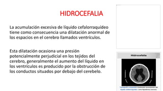 HIDROCEFALIA
La acumulación excesiva de líquido cefalorraquídeo
tiene como consecuencia una dilatación anormal de
los espacios en el cerebro llamados ventrículos.
Esta dilatación ocasiona una presión
potencialmente perjudicial en los tejidos del
cerebro, generalmente el aumento del líquido en
los ventrículos es producido por la obstrucción de
los conductos situados por debajo del cerebelo.
 