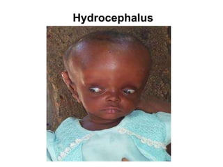 Hydrocephalus 