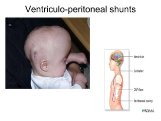 Ventriculo-peritoneal shunts 