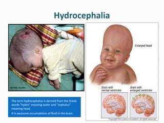 The term hydrocephalus is derived from the Greek
words "hydro" meaning water and "cephalus"
meaning head.
It is excessive accumulation of fluid in the brain.
 