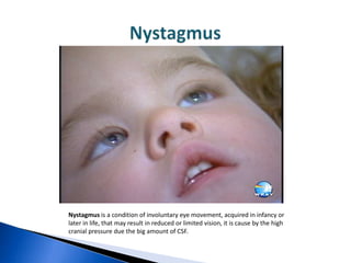 Nystagmus is a condition of involuntary eye movement, acquired in infancy or
later in life, that may result in reduced or limited vision, it is cause by the high
cranial pressure due the big amount of CSF.
 