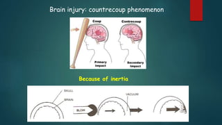 Brain injury: countrecoup phenomenon
Because of inertia
 