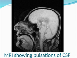 the formation and circulation of CEREBROSPINAL FLUID 2018.ppt