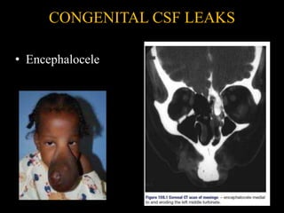 CONGENITAL CSF LEAKS
• Encephalocele
 