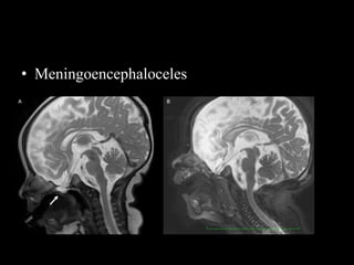 • Meningoencephaloceles
 