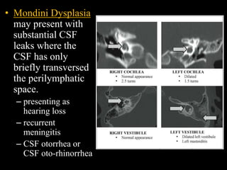 • Mondini Dysplasia
may present with
substantial CSF
leaks where the
CSF has only
briefly transversed
the perilymphatic
space.
– presenting as
hearing loss
– recurrent
meningitis
– CSF otorrhea or
CSF oto-rhinorrhea
 