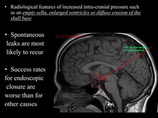 • Radiological features of increased intra-cranial pressure such
as an empty sella, enlarged ventricles or diffuse erosion of the
skull base
• Spontaneous
leaks are most
likely to recur
• Success rates
for endoscopic
closure are
worse than for
other causes
 