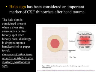 • Halo sign has been considered an important
marker of CSF rhinorrhea after head trauma.
The halo sign is
considered present
when a clear ring
surrounds a central
bloody spot after
bloody nasal discharge
is dropped upon a
handkerchief or paper
towel.
Presence of either tears
or saliva is likely to give
a falsely positive halo
sign.
 