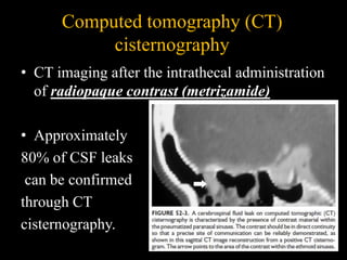Computed tomography (CT)
cisternography
• CT imaging after the intrathecal administration
of radiopaque contrast (metrizamide)
• Approximately
80% of CSF leaks
can be confirmed
through CT
cisternography.
 