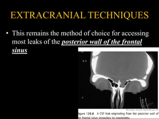 EXTRACRANIAL TECHNIQUES
• This remains the method of choice for accessing
most leaks of the posterior wall of the frontal
sinus
 