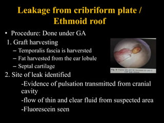 Leakage from cribriform plate /
Ethmoid roof
• Procedure: Done under GA
1. Graft harvesting
– Temporalis fascia is harversted
– Fat harvested from the ear lobule
– Septal cartilage
2. Site of leak identified
-Evidence of pulsation transmitted from cranial
cavity
-flow of thin and clear fluid from suspected area
-Fluorescein seen
 