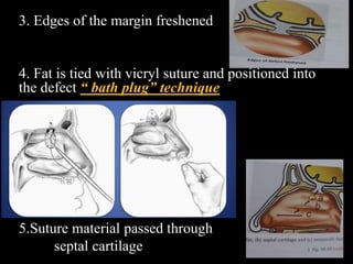 3. Edges of the margin freshened
4. Fat is tied with vicryl suture and positioned into
the defect “ bath plug” technique
5.Suture material passed through
septal cartilage
 