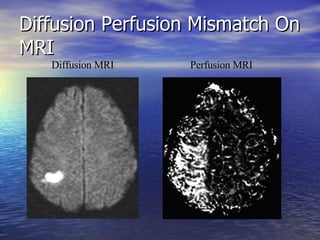 Diffusion Perfusion Mismatch On MRI Diffusion MRI Perfusion MRI 