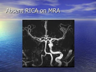 Absent RICA on MRA 