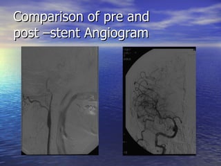 Comparison of pre and  post –stent Angiogram 