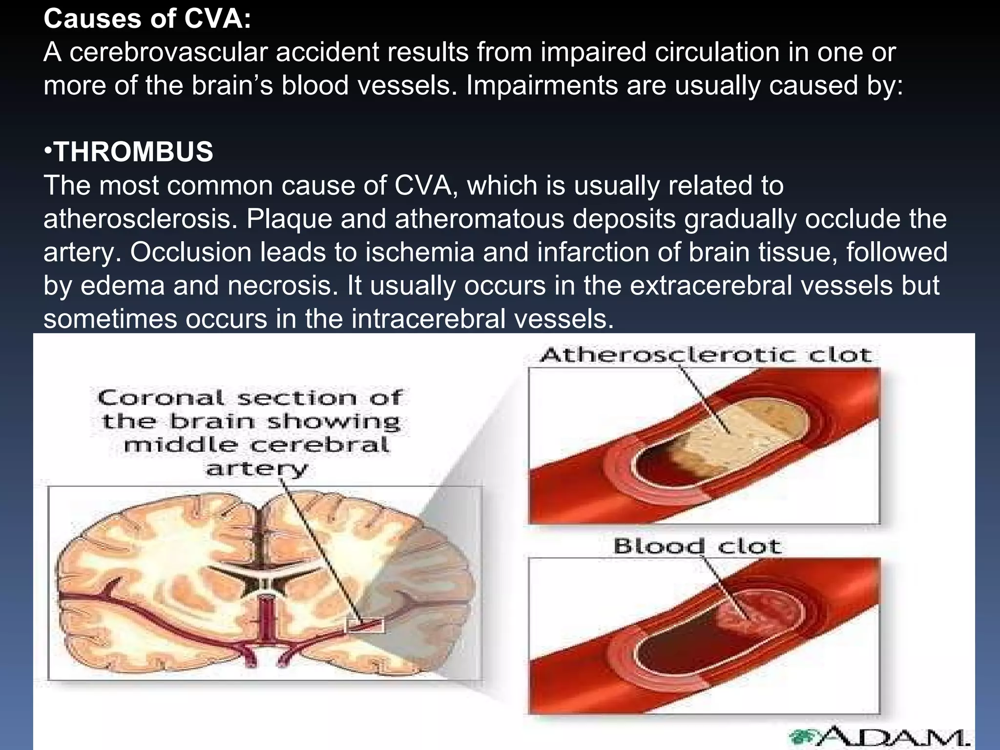Causes of CVA: A cerebrovascular accident results from impaired circulation in one or more of the brain’s blood vessels. Impairments are usually caused by: THROMBUS The most common cause of CVA, which is usually related to atherosclerosis. Plaque and atheromatous deposits gradually occlude the artery. Occlusion leads to ischemia and infarction of brain tissue, followed by edema and necrosis. It usually occurs in the extracerebral vessels but sometimes occurs in the intracerebral vessels. 