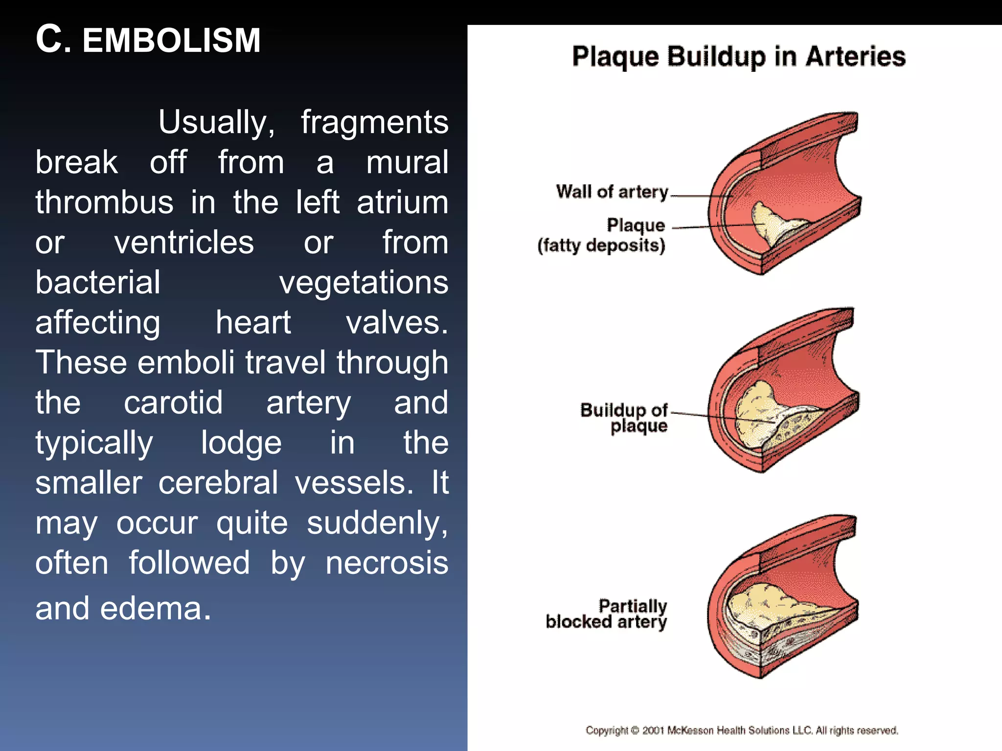 C . EMBOLISM Usually, fragments break off from a mural thrombus in the left atrium or ventricles or from bacterial vegetations affecting heart valves. These emboli travel through the carotid artery and typically lodge in the smaller cerebral vessels. It may occur quite suddenly, often followed by necrosis and edema . 