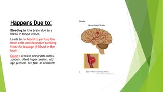 Cerebrovascular accident(cva) stroke | PPT