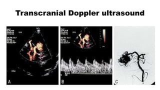 Transcranial Doppler ultrasound
 