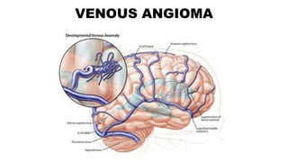VENOUS ANGIOMA
 