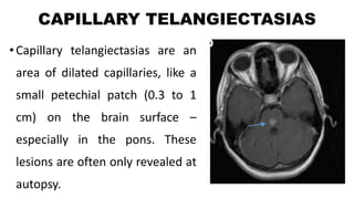 CAPILLARY TELANGIECTASIAS
• Capillary telangiectasias are an
area of dilated capillaries, like a
small petechial patch (0.3 to 1
cm) on the brain surface –
especially in the pons. These
lesions are often only revealed at
autopsy.
 