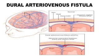 DURAL ARTERIOVENOUS FISTULA
 